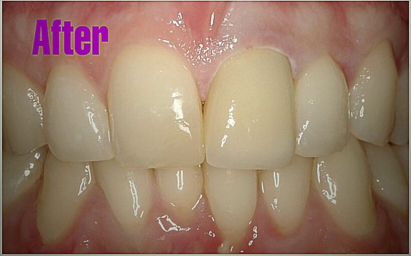 Front tooth after new porcelain crown