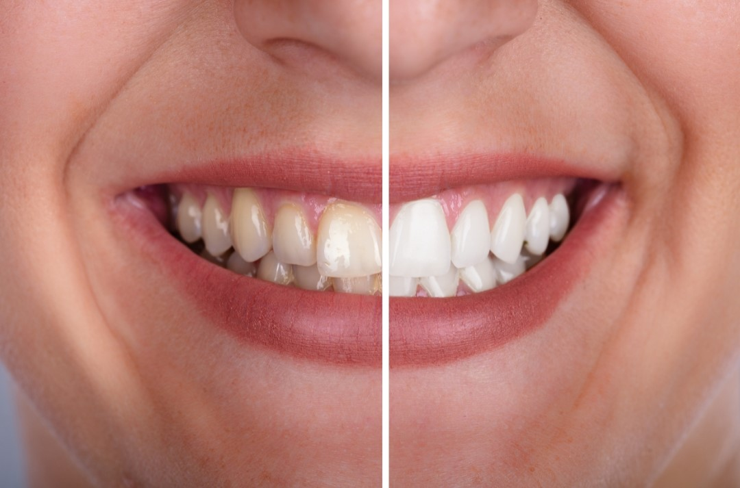 Split smile comparison showing brighter teeth after whitening