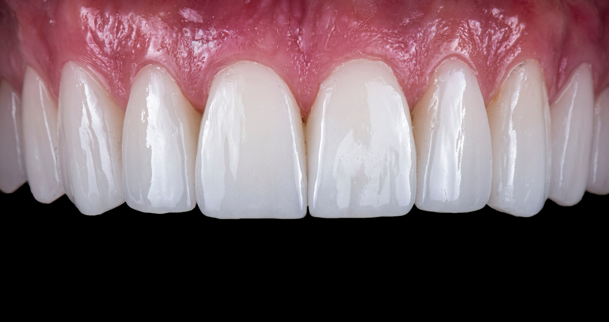 Close-up of natural-looking porcelain veneers