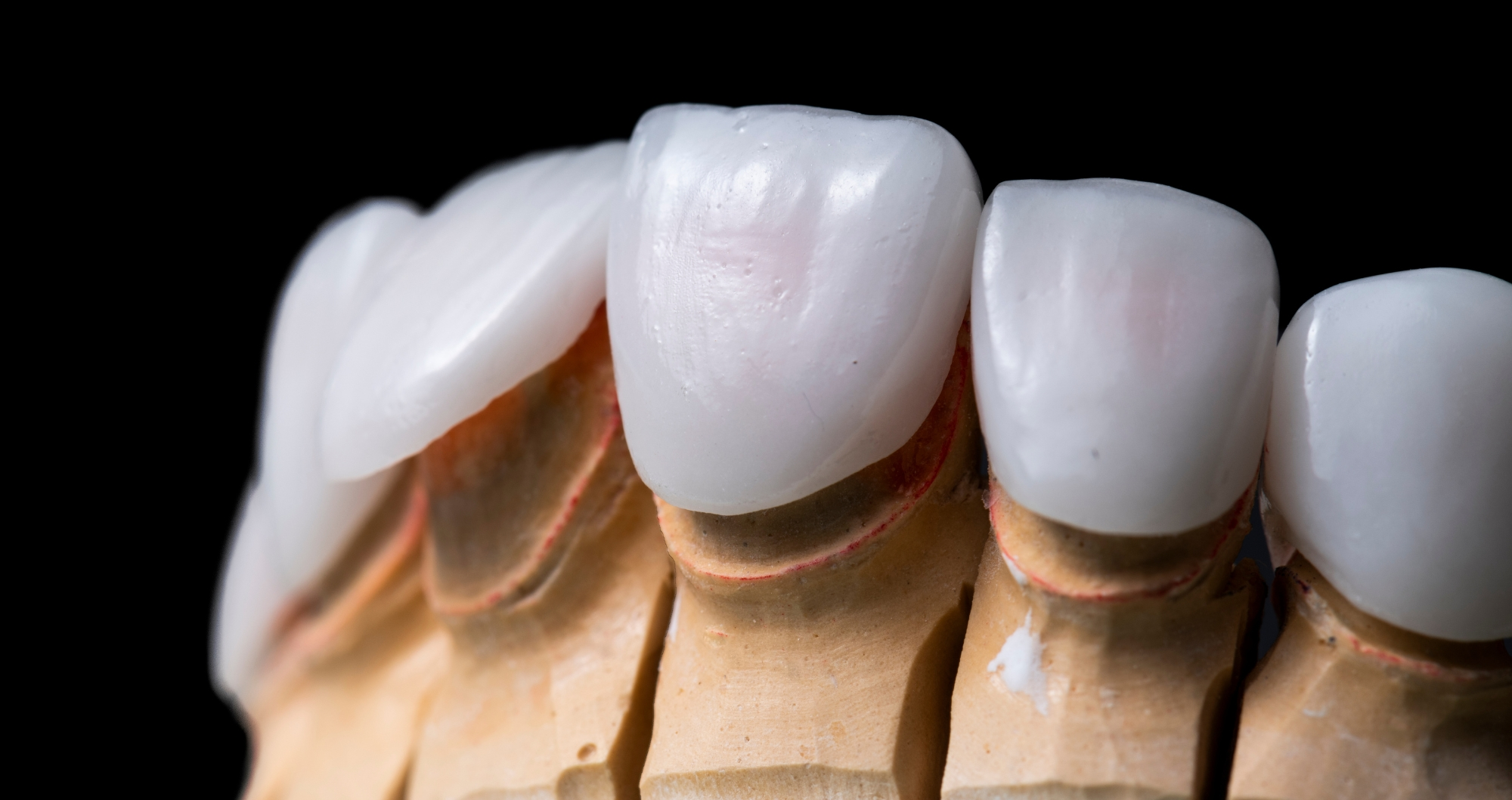 Detail of porcelain veneer shells before fitting