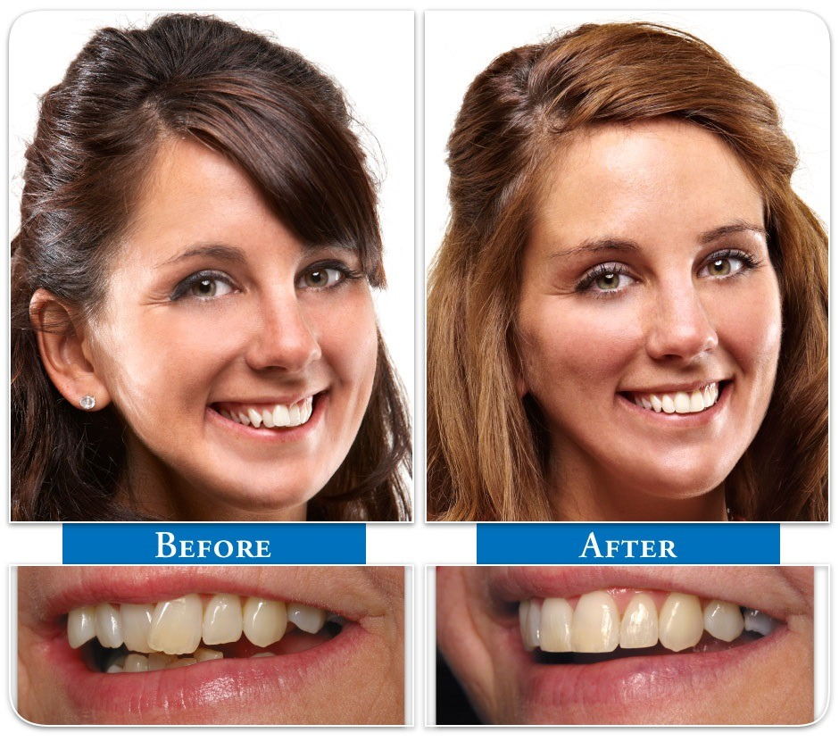 Smile transformation before and after