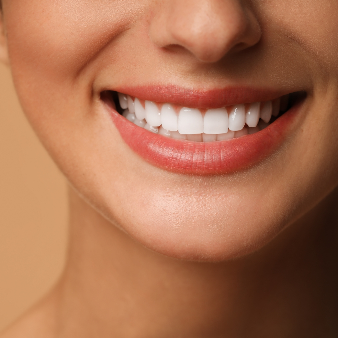 A bright, even smile after porcelain veneers