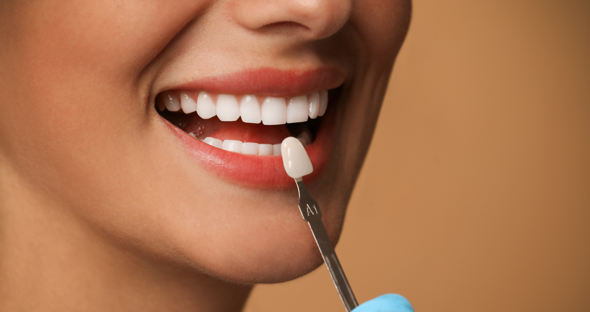 Veneer shade selection at Woodbridge Hill Dental Practice