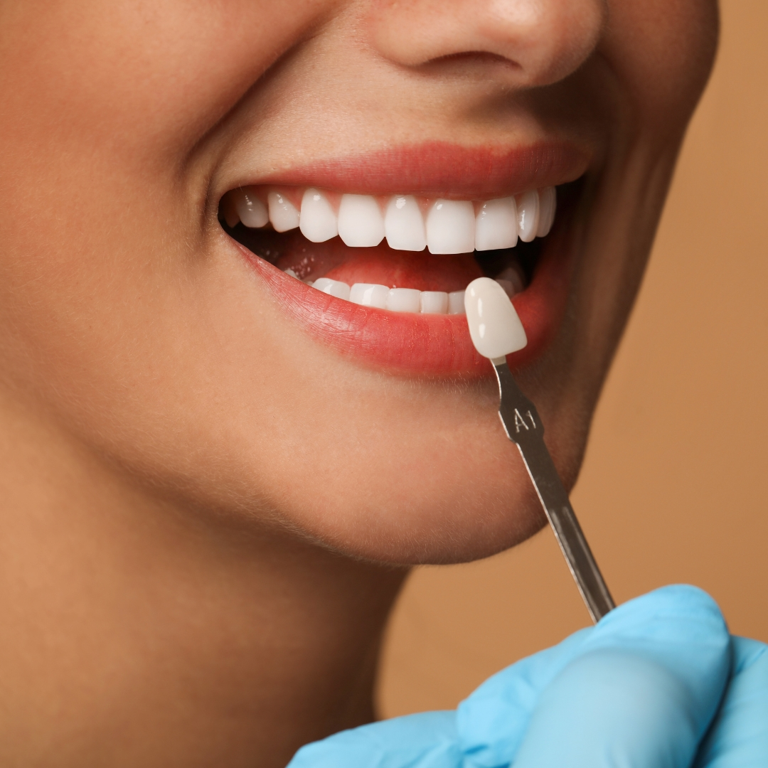 Veneer shade matching at Woodbridge Hill Dental Practice