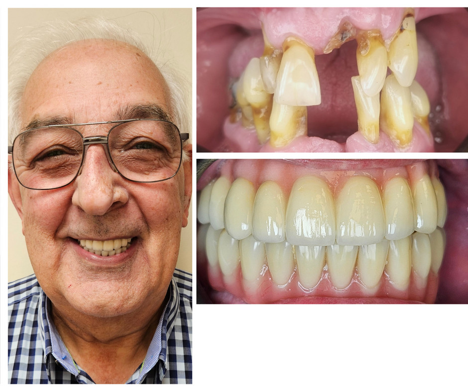 Dental implant before and after case study