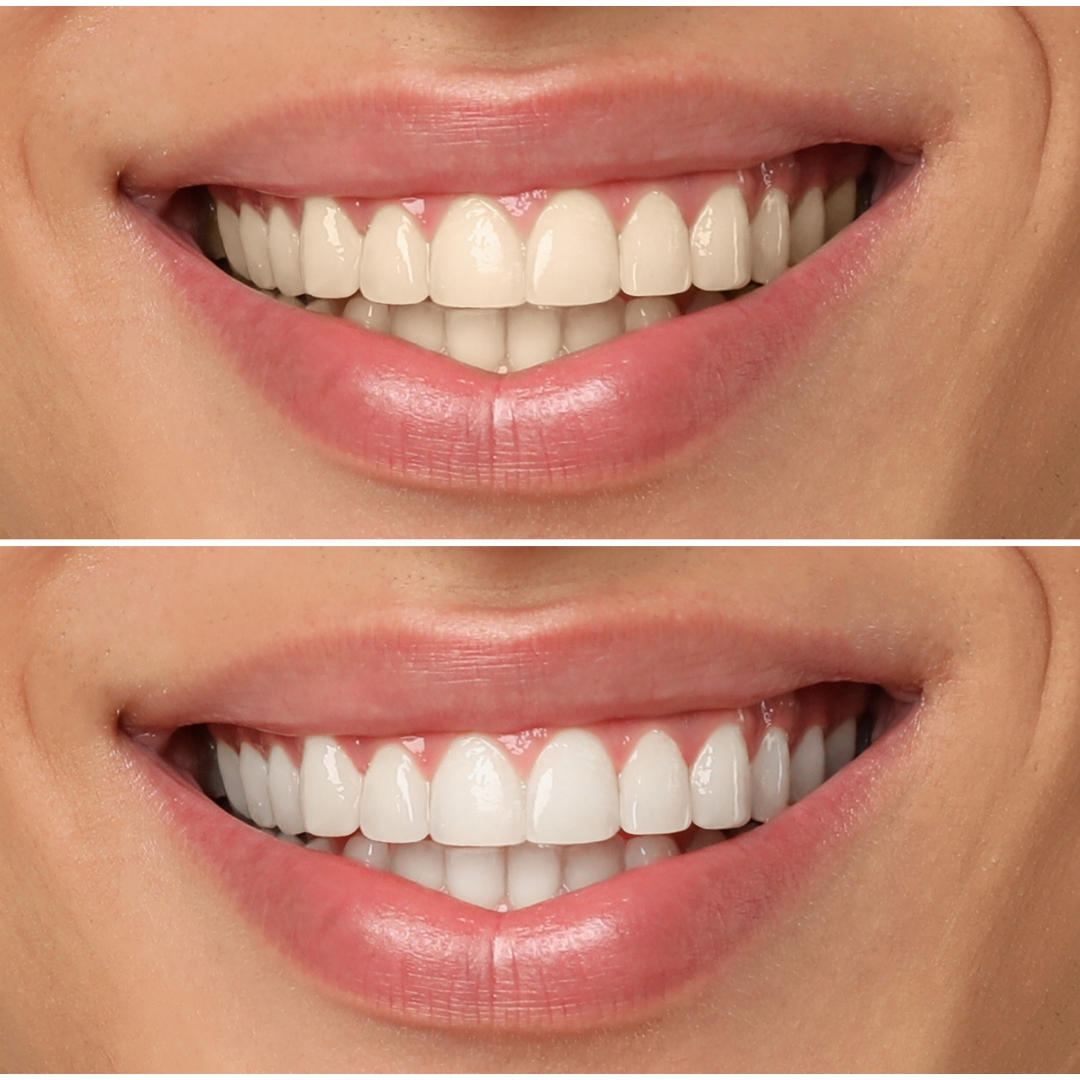 Stacked smile images showing brightened teeth after whitening