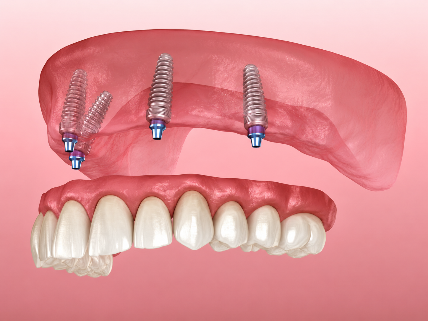 Same day teeth extraction and immediate implant replacement