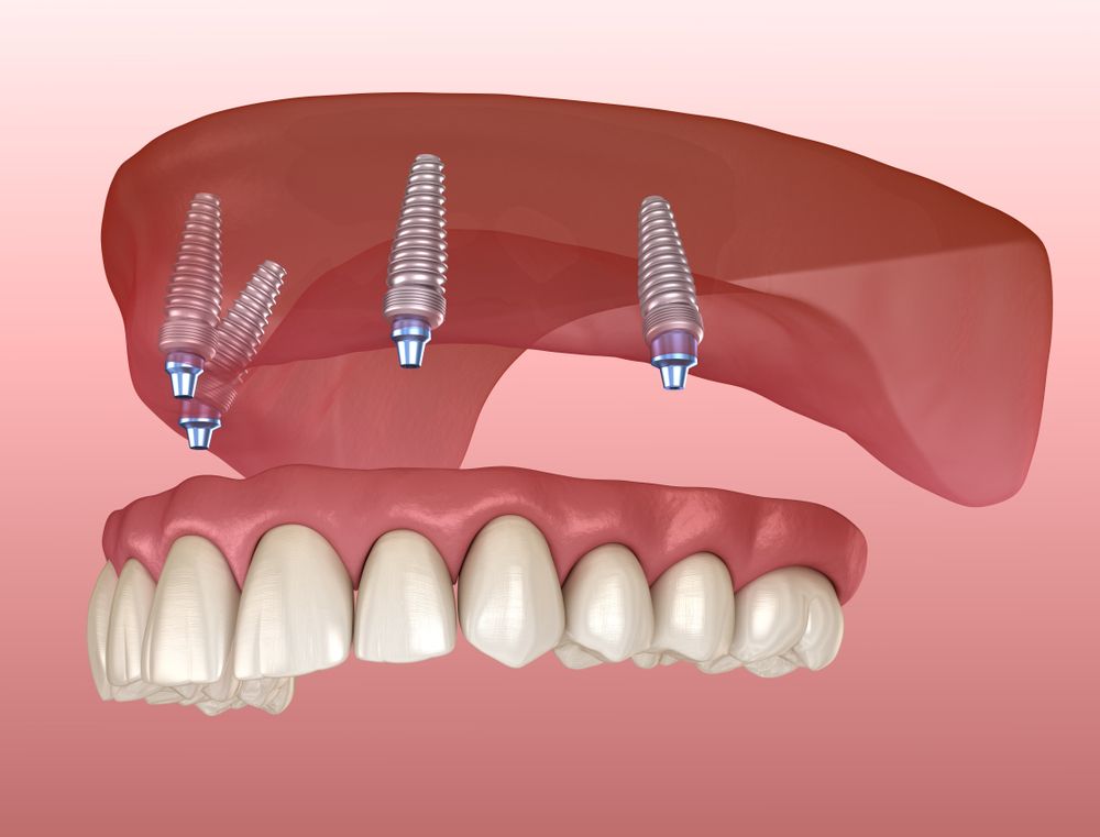 Illustration of an All-on-4 full-arch implant restoration