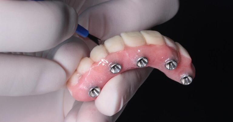 All-on-4 prosthesis showing four implant attachments