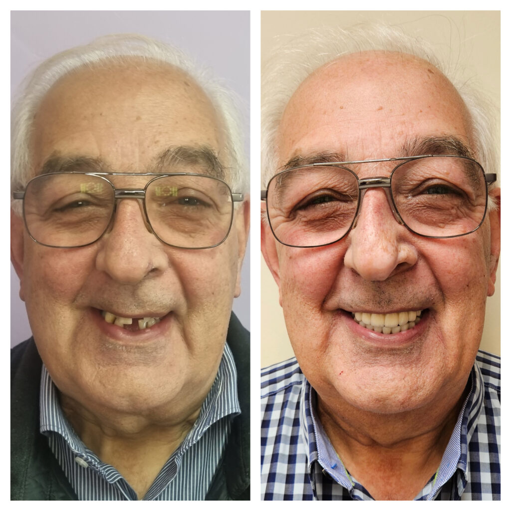 Case 1 — facial before and after