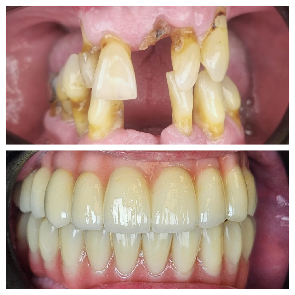 Case 1 — intra-oral before and after