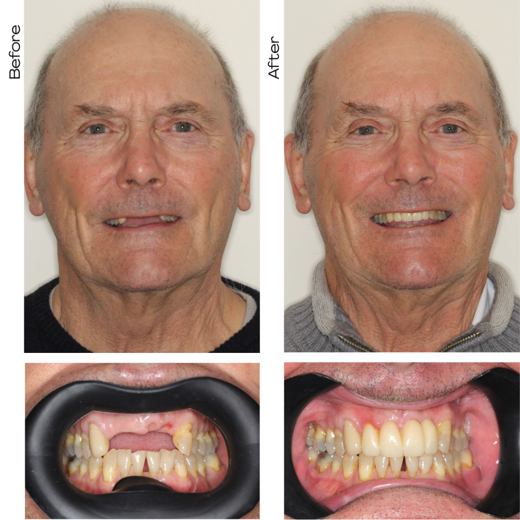 Full mouth implant rehabilitation — before and after