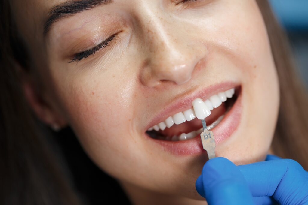 Composite bonding shade matching at Woodbridge Hill Dental Practice
