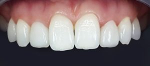 Emax Porcelain Crowns — after