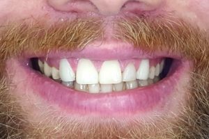 Emax Full Porcelain Crowns — after