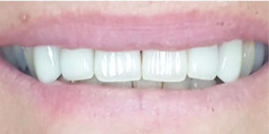 Emax Full Porcelain Crowns — after