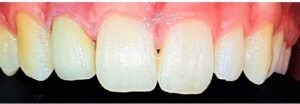 Zirconia Crown — after