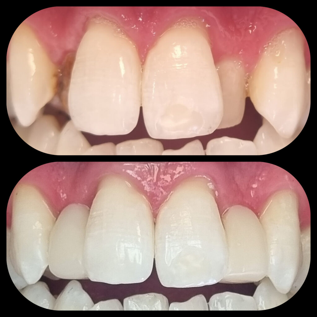 Composite Bonding Case 1 — before and after