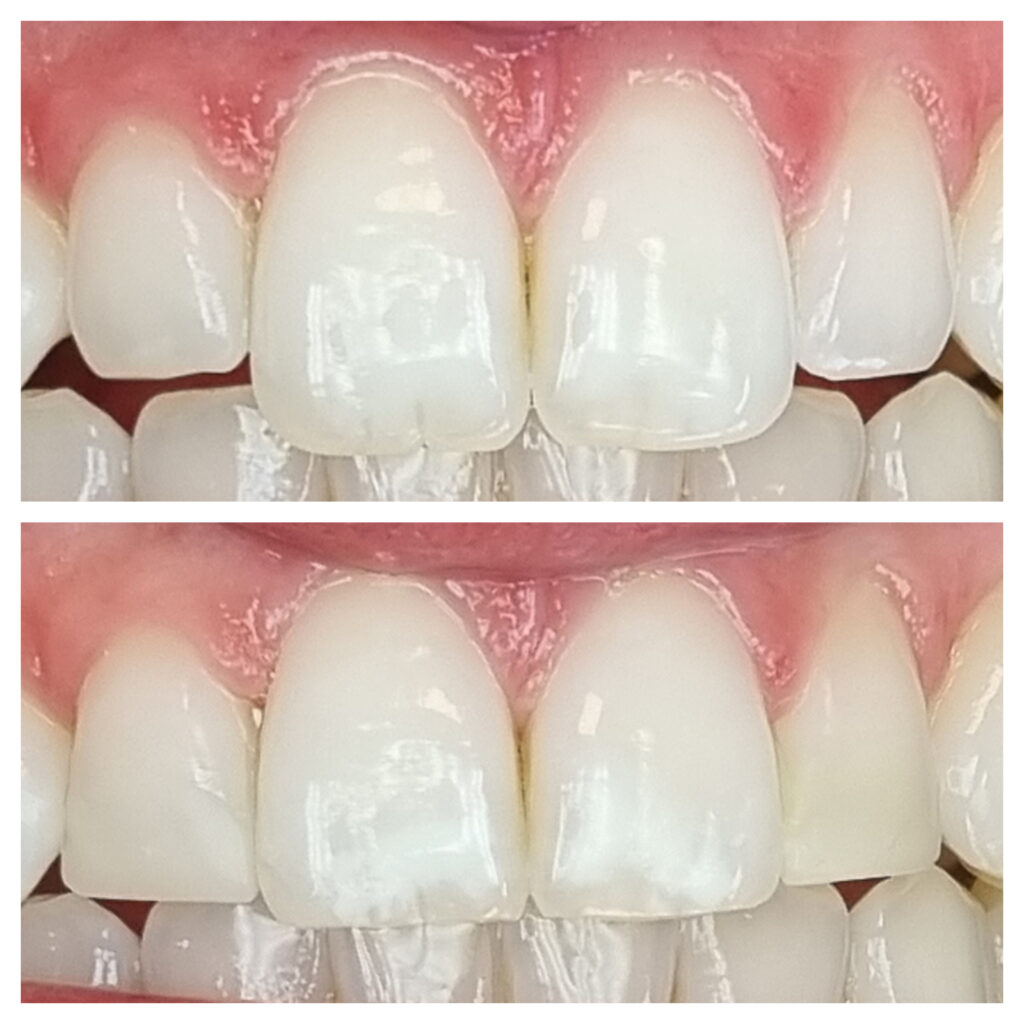 Composite Bonding Case 2 — before and after