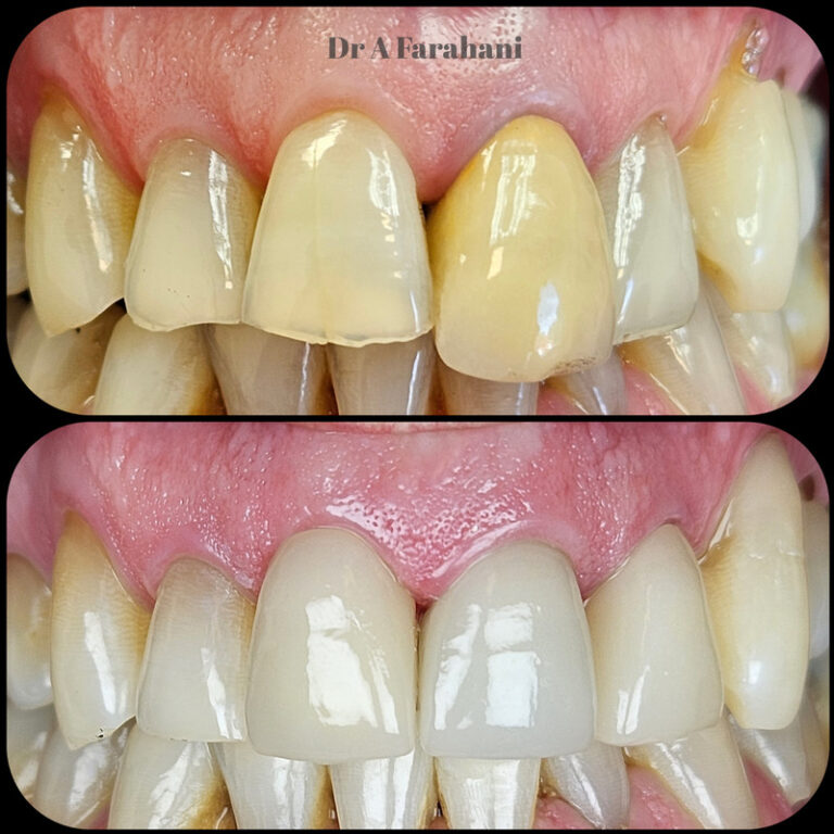 Dental crowns and veneers — before and after