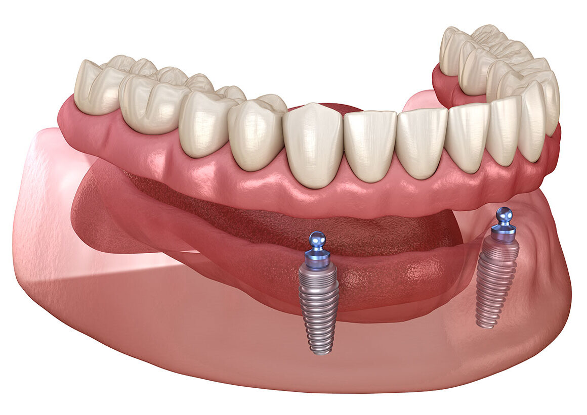 Implant-Supported Dentures