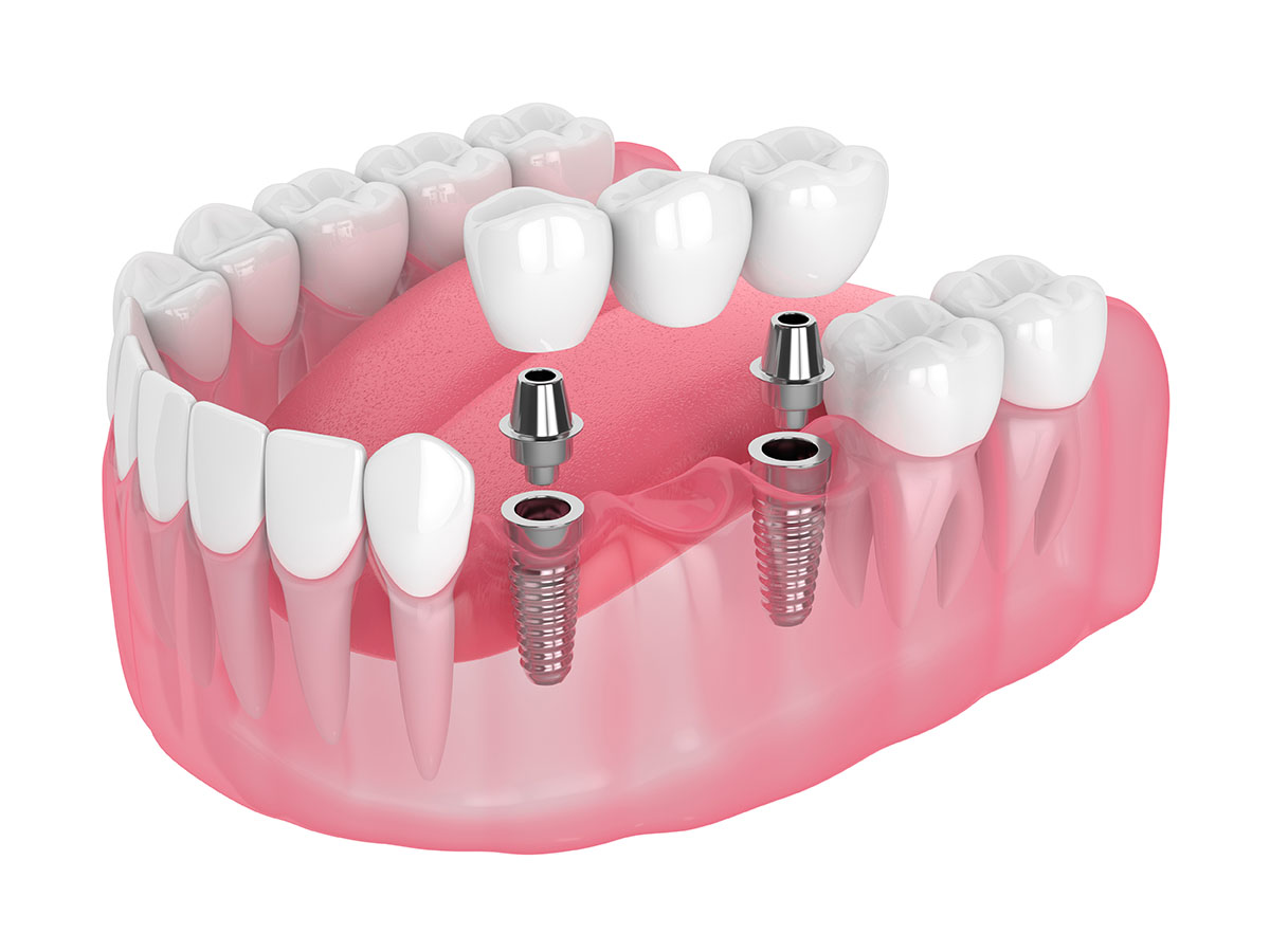 Multiple Implants