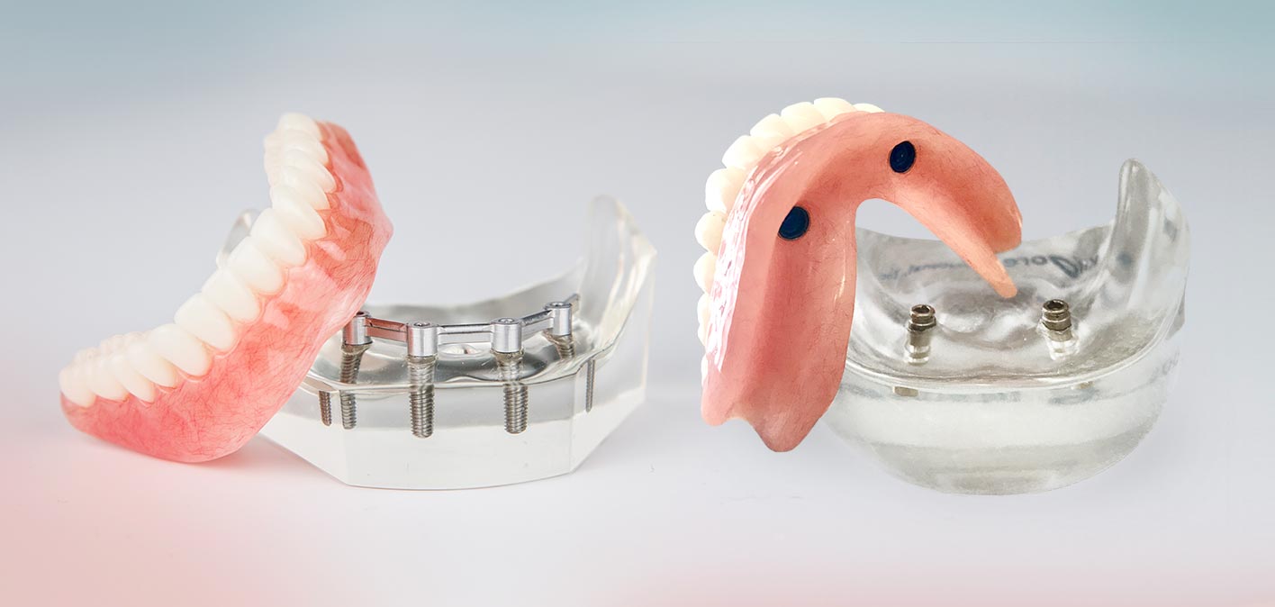 Model showing implant-retained dentures and their attachments