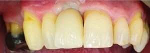 Single Implant — after