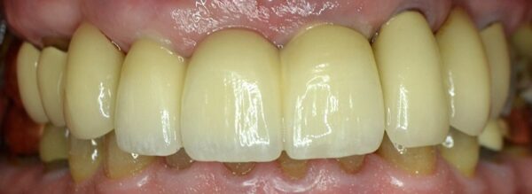 Multiple Implants — after