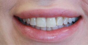 Single Implant — after