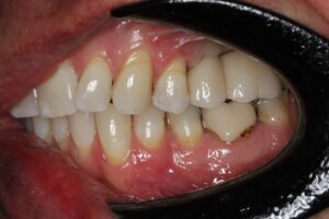 Single Tooth Implant — after