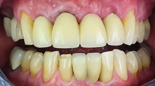 After
