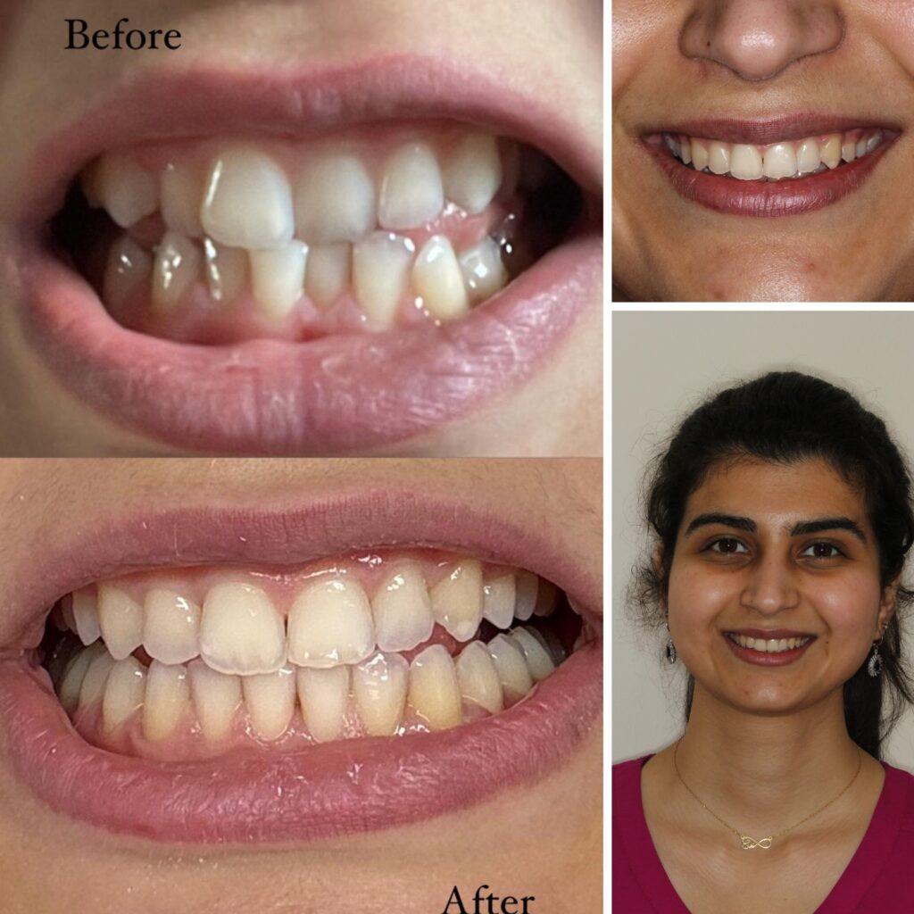 Six Month Smiles — full case before and after