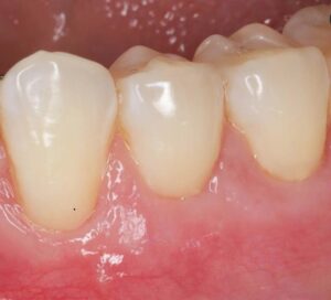 Graft for Receding Gums — after