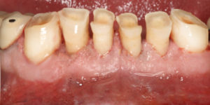 Crown Lengthening — after