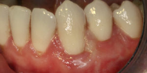 Soft Tissue Graft — after