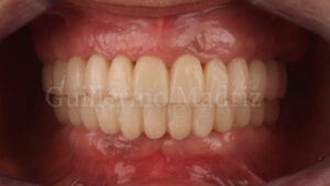 Smile Make-Over with Implants — after
