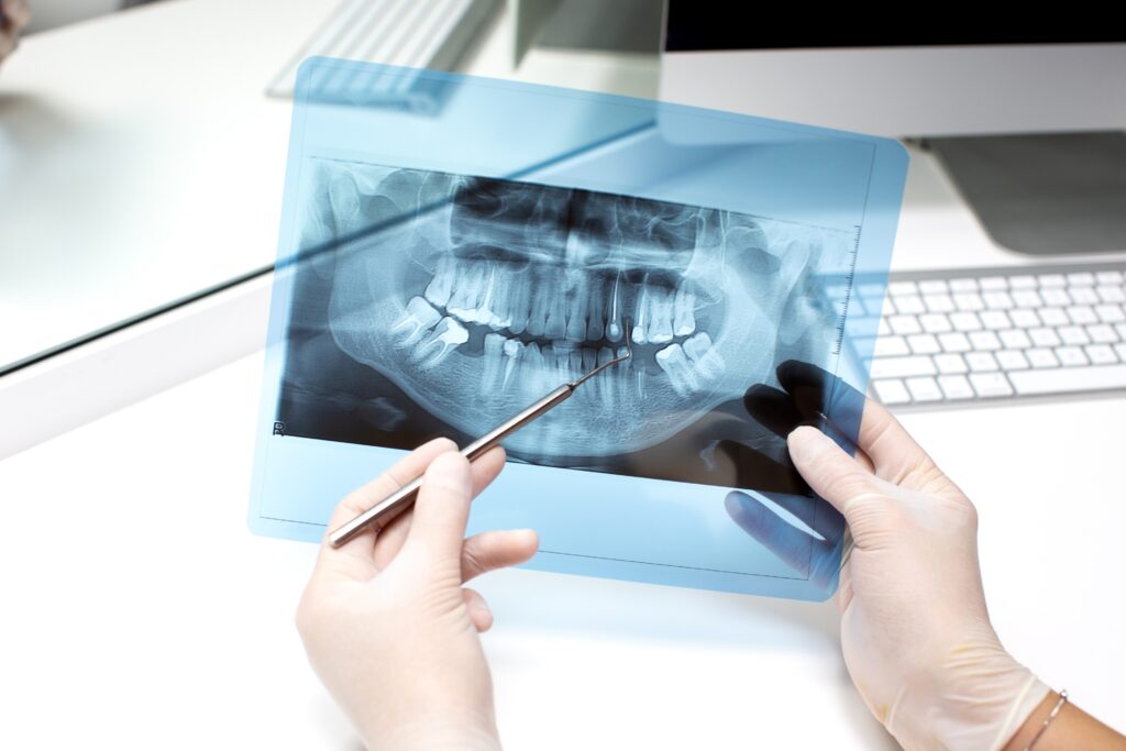 Dental X-ray used to diagnose root canal infection
