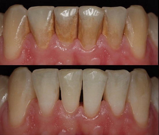 Scale and polish before and after at Woodbridge Hill Dental Practice