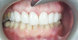 Emax Full Porcelain Veneers — after